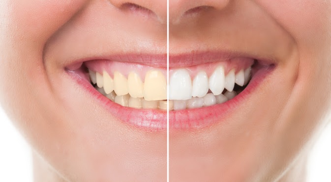 How Whitening Teeth Increases Confidence