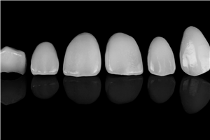 veneers Ocean Springs 